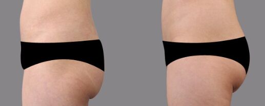 吸脂瘦臀的果怎么样