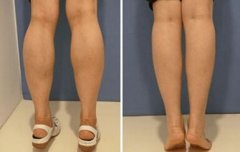 注射注射瘦脸注射瘦腿几天起