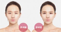 埋线双眼皮术后不满意什么时候能拆线
