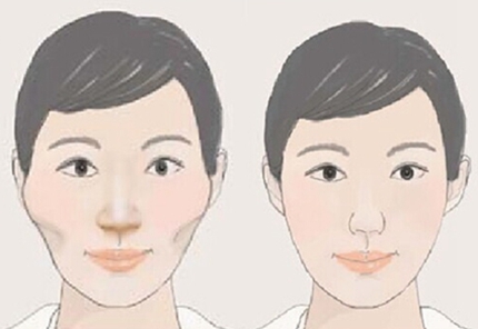 广州曙光医学美容医院,颧骨手术,怎么样,多少钱