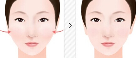 广州曙光医学美容医院,颧骨手术,怎么样,多少钱