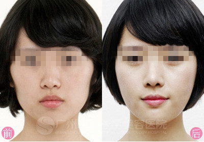 广州曙光医学美容医院,颧骨手术,怎么样,多少钱