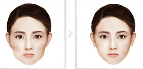 广州曙光医学美容医院,颧骨手术,怎么样,多少钱