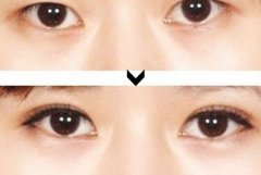 三点定位双眼皮手术果如何