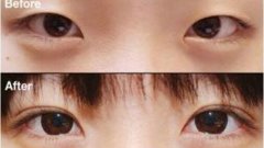 三点定位双眼皮太宽了怎么办