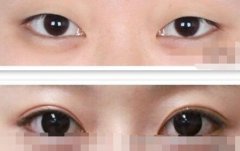 三点定位双眼皮手术多少钱