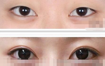 三点定位双眼皮手术多少钱