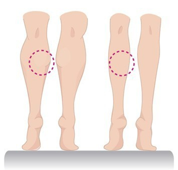 小腿太粗,怎么办,吸脂瘦小腿,会留疤吗