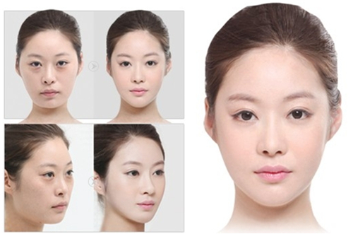 上海第九人民医院,去眼袋,多少钱