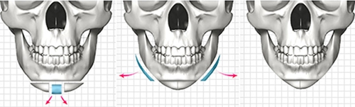 上海华美医疗美容医院,v-line手术,怎么样