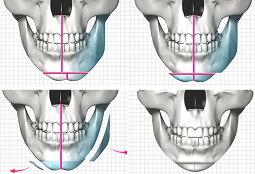 上海华美医疗美容医院,v-line手术,怎么样