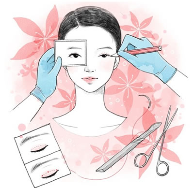 韩式微创双眼皮手术