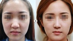 鼻头缩小一般需要多少钱