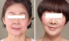 注射伊w兰除皱纹成好吗