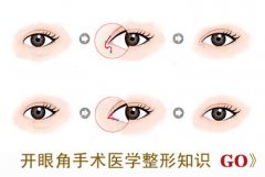 开内眼角出现疤痕怎么办 开内眼角出现疤痕怎么办