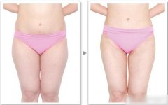 大腿吸脂术后该注意什么