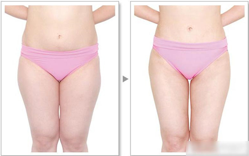 大腿吸脂,术后,该注意什么