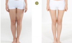 腿部吸脂会有后遗症吗