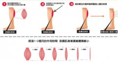 注射瘦腿的果可以维持多久 注射瘦腿的果可以维持多久