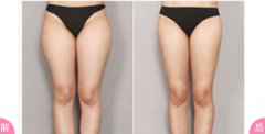 大腿吸脂和小腿吸脂有什么不同