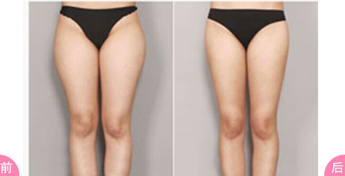 大腿吸脂和小腿吸脂有什么不同