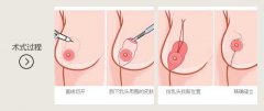 生完孩子乳房下垂怎么办 乳房下垂矫正会留疤吗 生完孩子乳房下垂怎么办 乳房下垂矫正会留疤吗