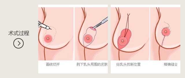 生完孩子,乳房下垂,怎么办,乳房下垂矫正,会留疤吗