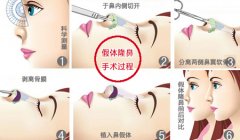 假体隆鼻用哪种材料好 假体隆鼻用哪种材料好