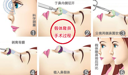 假体隆鼻,哪种,材料好