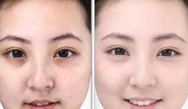 怎样抽脂去眼袋