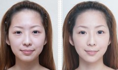 手术去眼袋的方法有哪些 手术去眼袋的方法有哪些