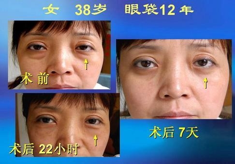 去眼袋做什么手术喜欢