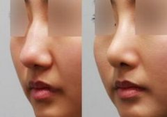 生态隆鼻一般用什么软骨材料 生态隆鼻一般用什么软骨材料