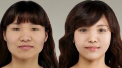 下颌骨整形会留疤痕吗
