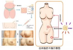 自体脂肪隆胸术小误区