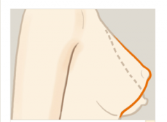 乳房下垂矫正我们应该注意事项是什么 乳房下垂矫正我们应该注意事项是什么