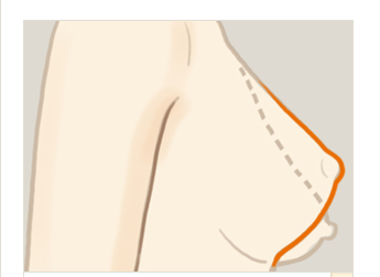 乳房下垂矫正我们应该注意事项是什么