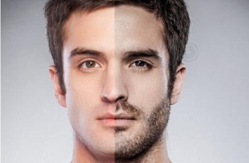 胡须移植,大概要,多少钱