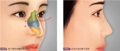 北京做鹰钩鼻矫正手术要多少钱