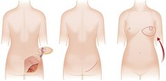沈阳乳房再造的价格是多少