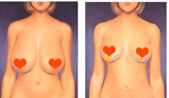 西安做乳房下垂矫正手术多少钱