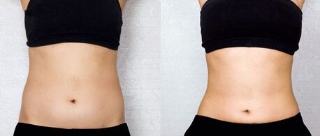 抽脂手术价格一般要多少