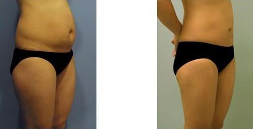 抽脂术后留疤怎么去掉