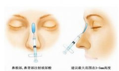 玻尿酸隆鼻是怎么做的 注射玻尿酸隆鼻能保持多久