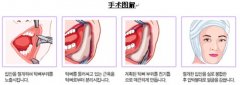 成都颧骨颧弓整形费用大概是多少