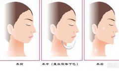 大连丰下颌一般要多少钱