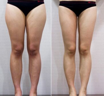 吸脂瘦腿会对肌肉有影响吗