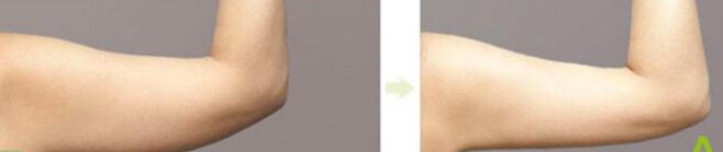 胳膊吸脂减肥需要多少钱