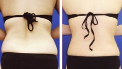 水动力吸脂优势有哪些