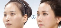 颧骨整形手术过程是怎么样的